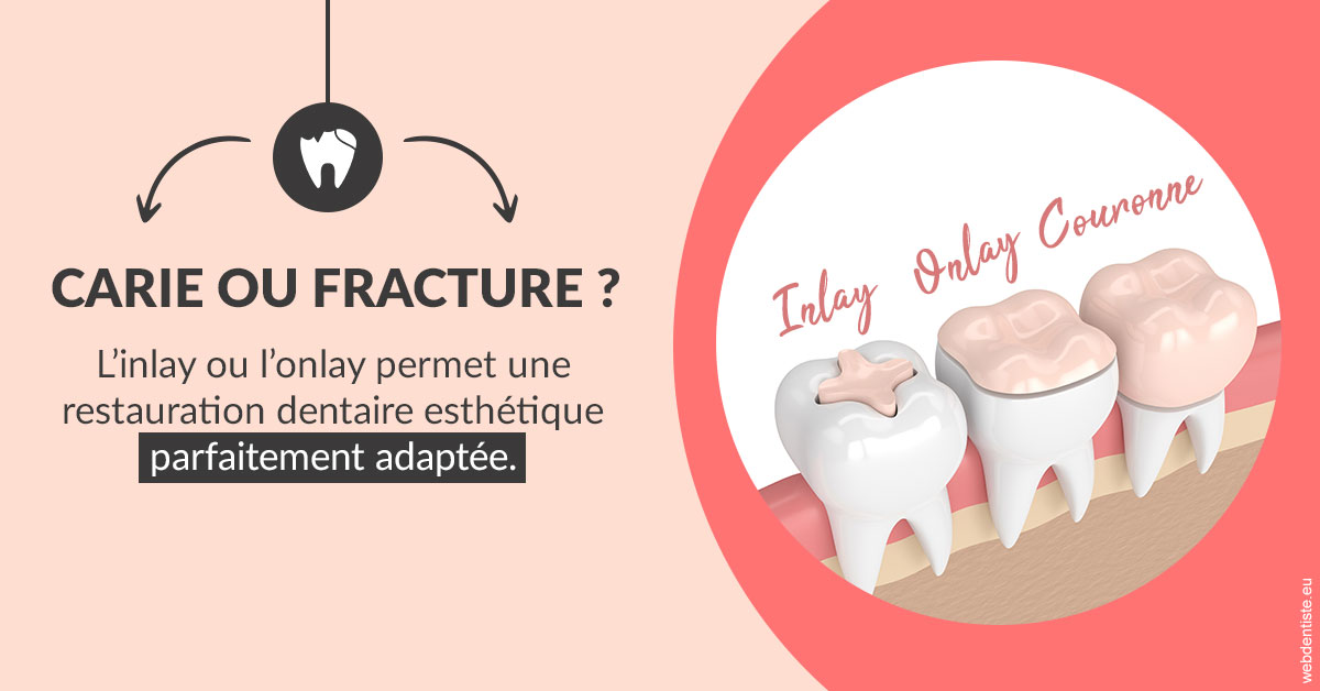 https://dr-lartaud-jean-marc.chirurgiens-dentistes.fr/T2 2023 - Carie ou fracture 2