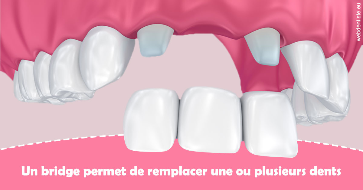 https://dr-lartaud-jean-marc.chirurgiens-dentistes.fr/Bridge remplacer dents 2