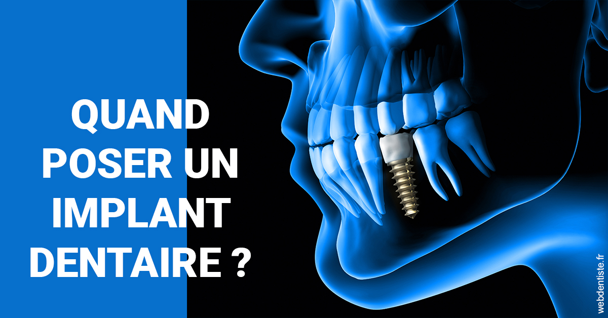 https://dr-lartaud-jean-marc.chirurgiens-dentistes.fr/Les implants 1