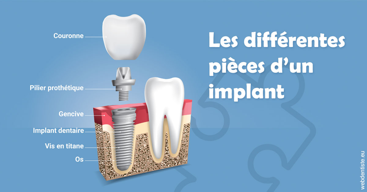 https://dr-lartaud-jean-marc.chirurgiens-dentistes.fr/Les différentes pièces d’un implant 1